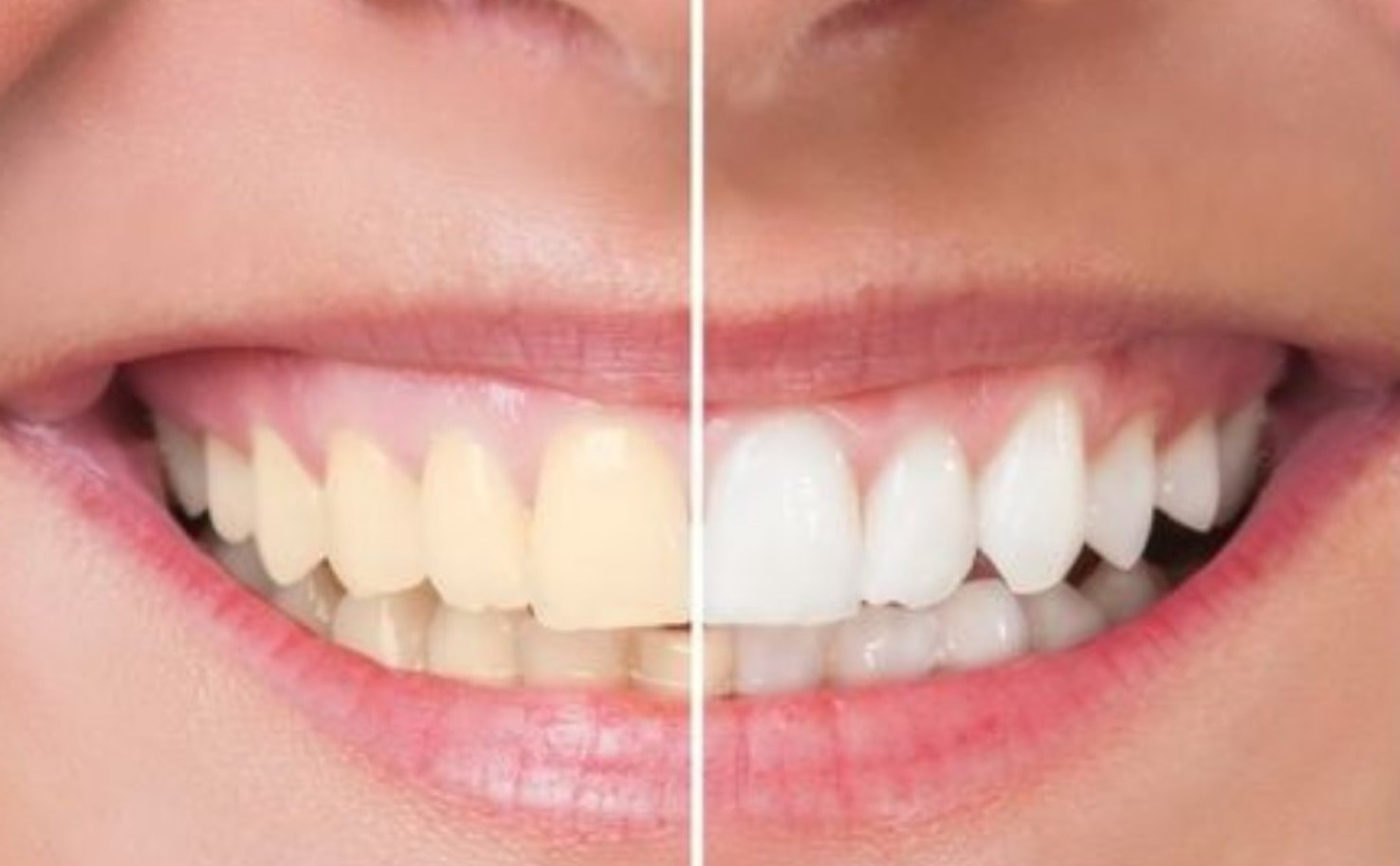 Teeth Whitening